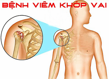 Viêm quanh khớp vai là gì? Chuẩn đoán Nguyên nhân Phương pháp điều trị