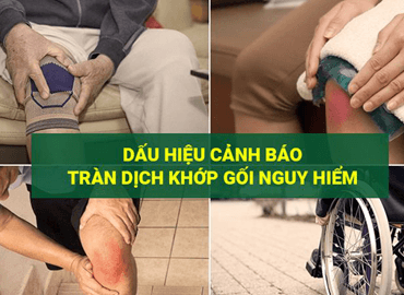 Viêm khớp gối tràn dịch là gì?Triệu chứng Nguyên Nhân [MỚI 2024]