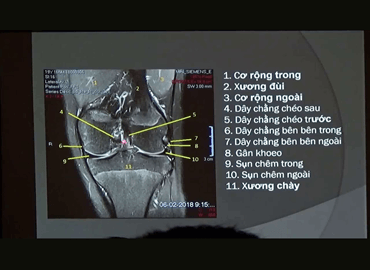 Giải phẫu khớp gối là gì