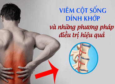 Viêm cột sống dính khớp: Nguyên nhân, triệu chứng, chẩn đoán và điều trị