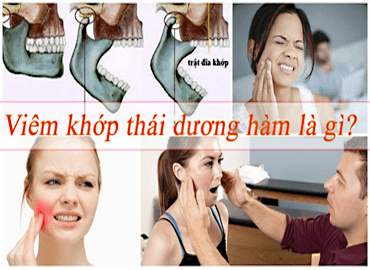 Viêm khớp thái dương hàm những điều cần biết